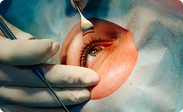 Glaucoma Surgery