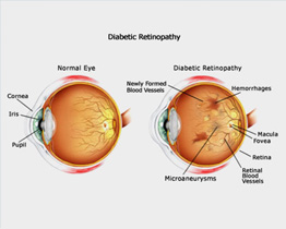 Diabetic Eye Disease & Management