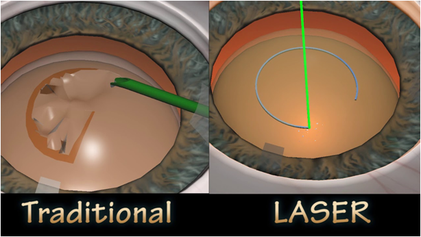 Femto Cataract Surgery In Sangli