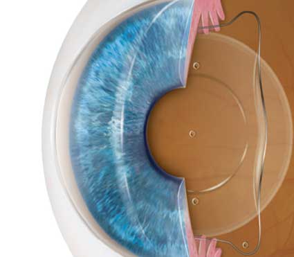 Implantable Contact Lens (ICL) In Beed