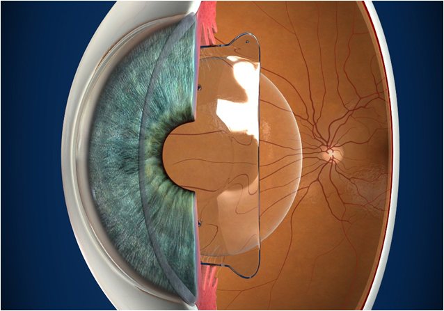 Refractive Surgery In Pune