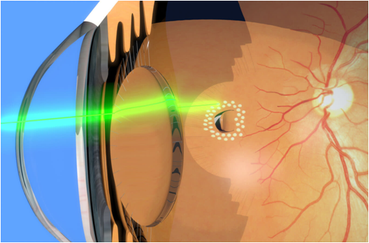 Retinal Hole Laser Treatment In Nanded
